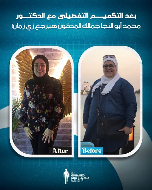 تجاربكم مع نزول الوزن بعد التكميم